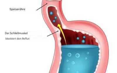 5 Vitamine zur natürlichen Bekämpfung von saurem Reflux